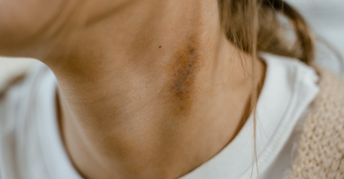 découvrez tout sur l'œsophagite à éosinophiles, une maladie inflammatoire de l'œsophage causée par une accumulation anormale de globules blancs, ses symptômes, diagnostic et traitements.